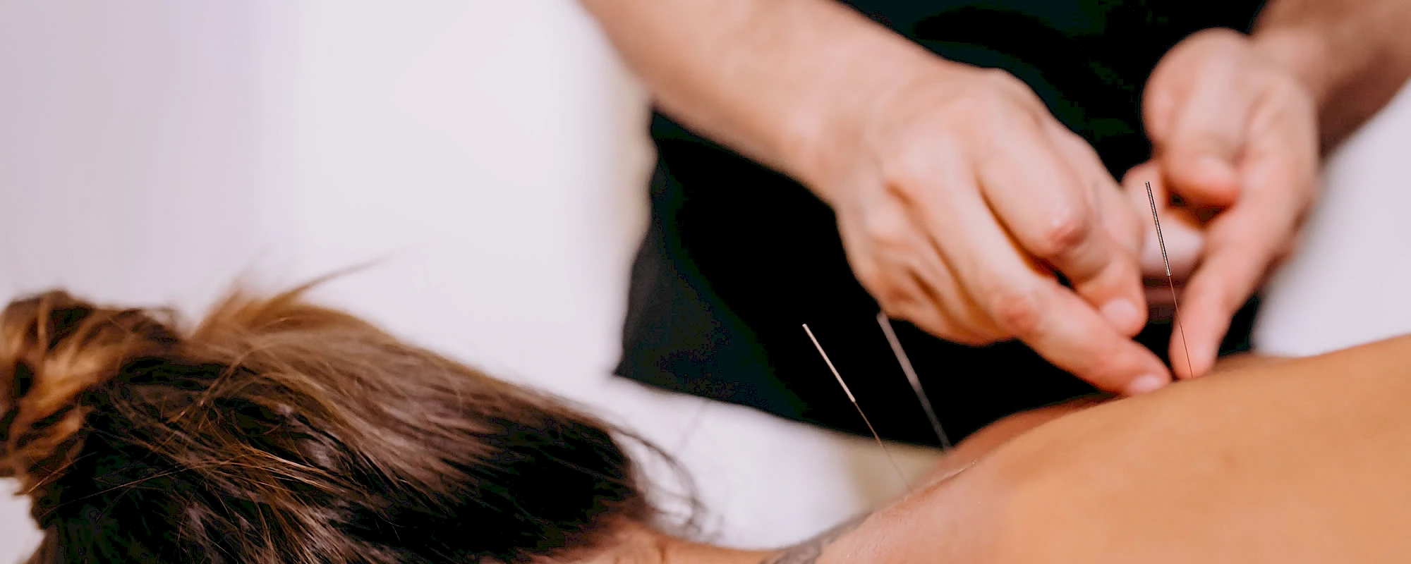 Acupuncture in Whitehorse